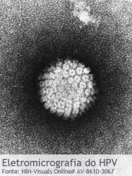 Vírus HPV causador das Verrugas Genitais