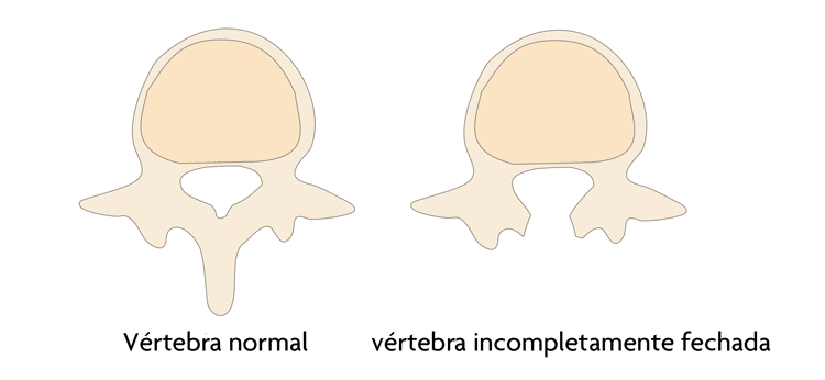 vértebra normal e incompletamente fechada em mielomeningocele