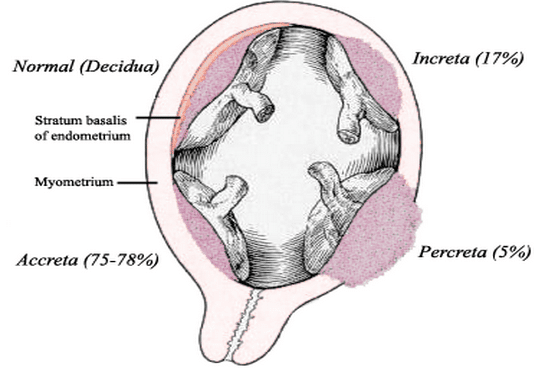 Placenta Acreta