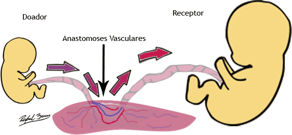 Anastomoses Placentárias na Transfusão Feto-Feto