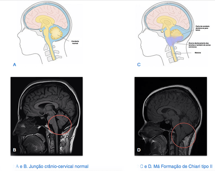 Malformação de Chiari Tipo II