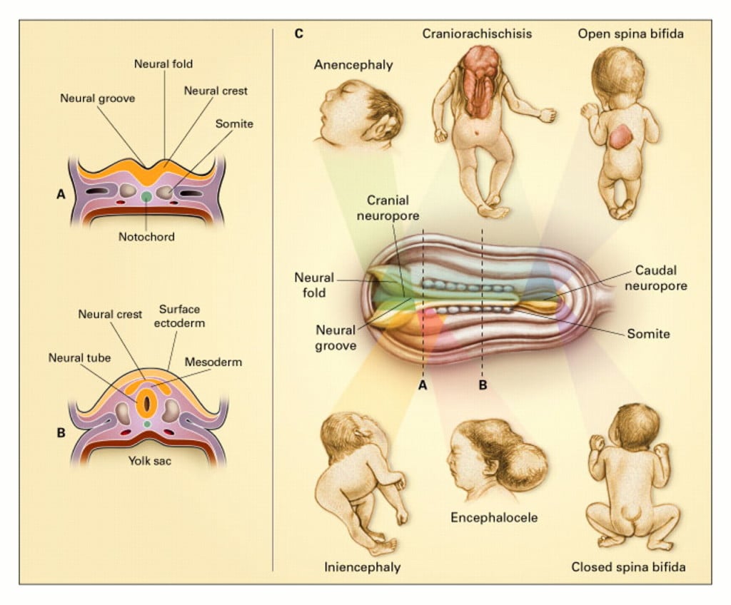 defeitos tubo neural