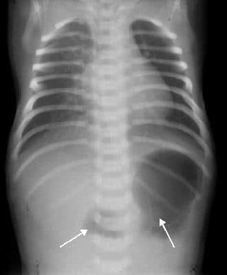 duodenal_atresia_rx