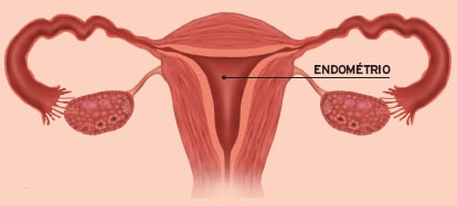 endometrio