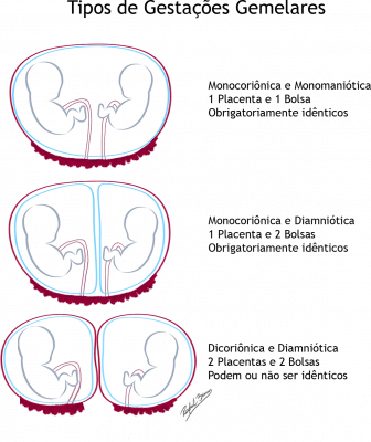 Tipos de Gestações Gemelares - Monocoriônica e Dicoriônica