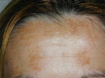 melasma