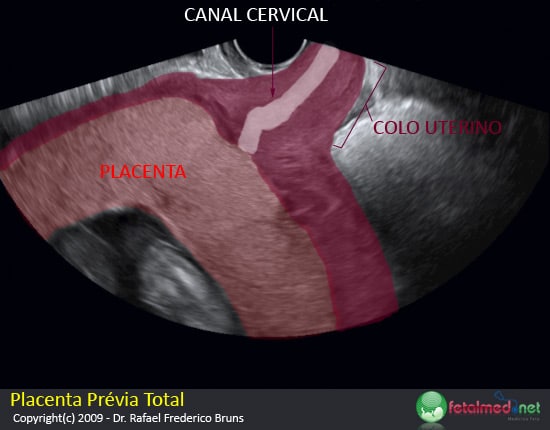 Placenta Prévia Total