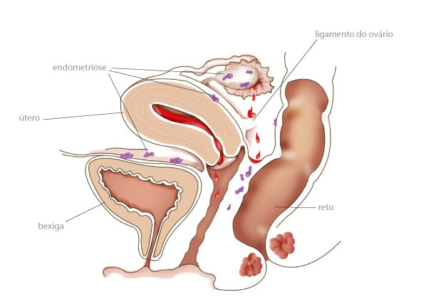 sitios-endometriose