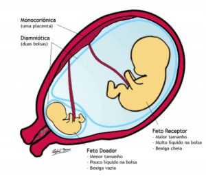 Síndrome da Transfusão Feto-Fetal