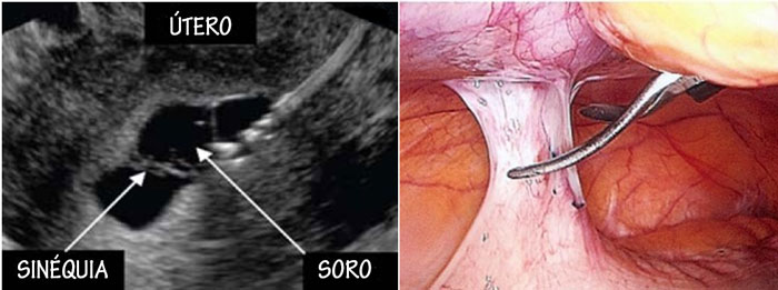 Sinéquia Uterina