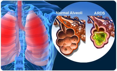 Alvéolo Pulmonar