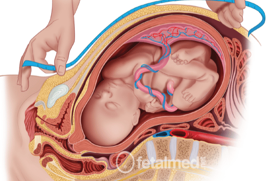 Altura Uterina: Por que meu médico mede minha barriga toda consulta?