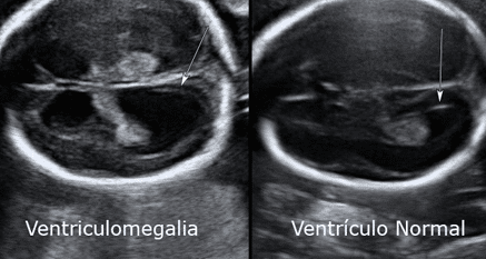 Ventriculomegalia fetal leve: diagnóstico, avaliação e conduta