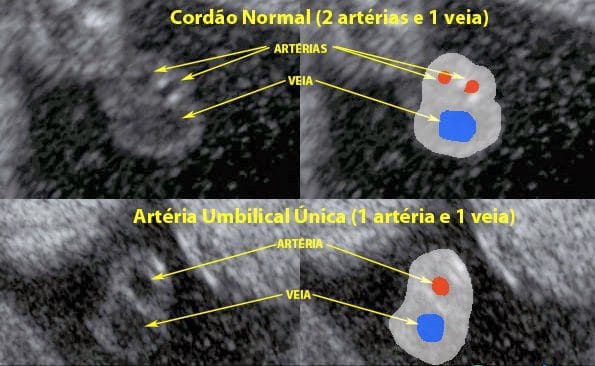 Artéria Umbilical Única