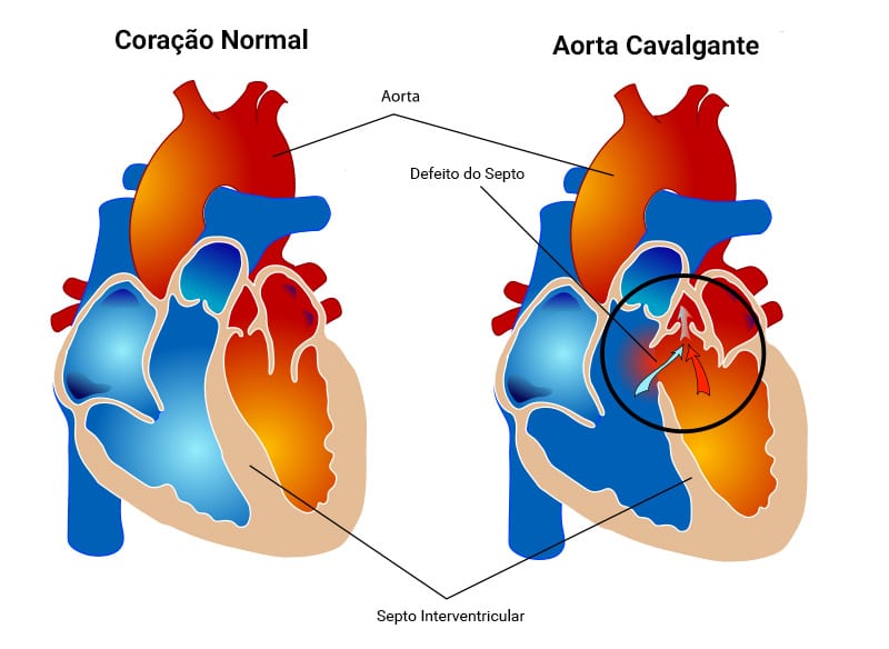 Cavalgamento de Aorta