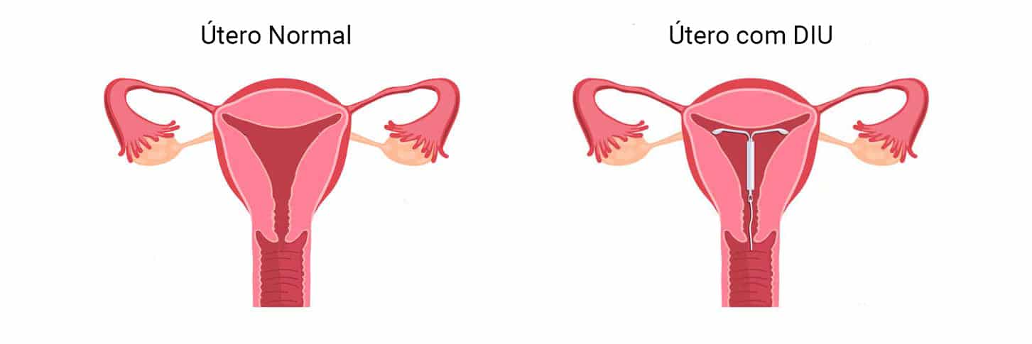 DIU - Dispositivo Intrauterino