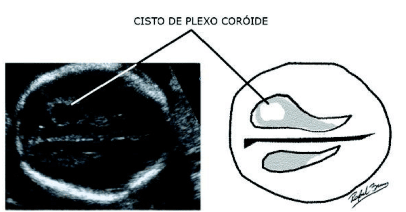 Cisto de Plexo Coróide