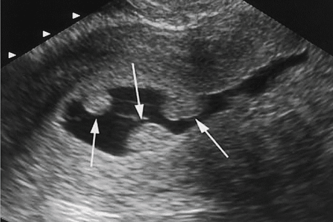 Polipo Endometrial