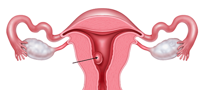 Como se trata um pólipo endometrial?