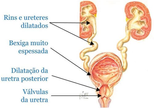 válvula de uretra posterior - esquema