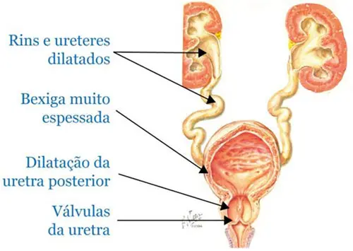 Válvula de Uretra Posterior
