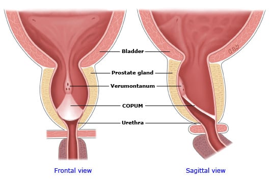 válvula de uretra posterior