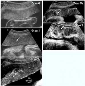 Desvendando o grau da placenta | Fetalmed - Medicina Fetal em Curitiba