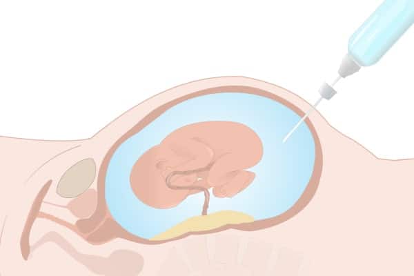 amniocentese amniodrenagem em casos de polidrâmnio