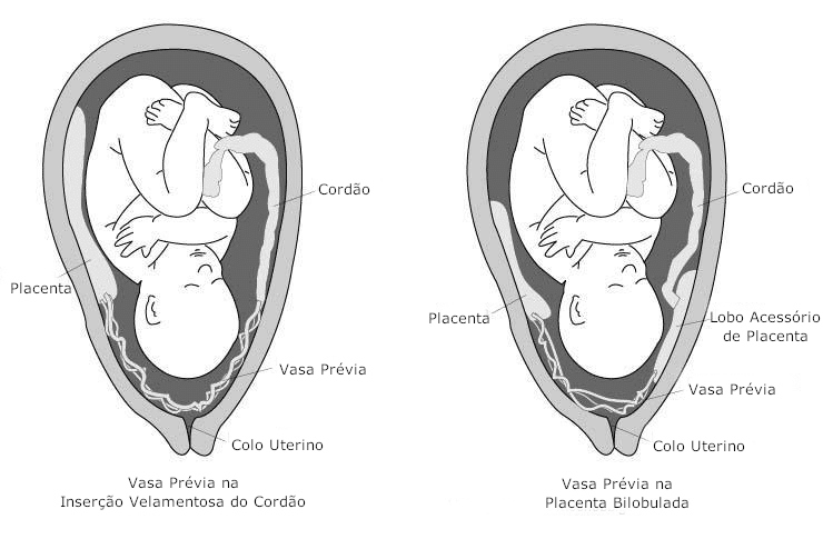 Diagrama Vasa Prévia