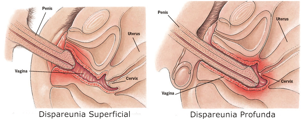 Dispareunia Superficial e Profunda