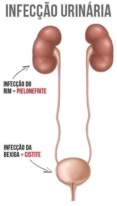 Infecção Urinária