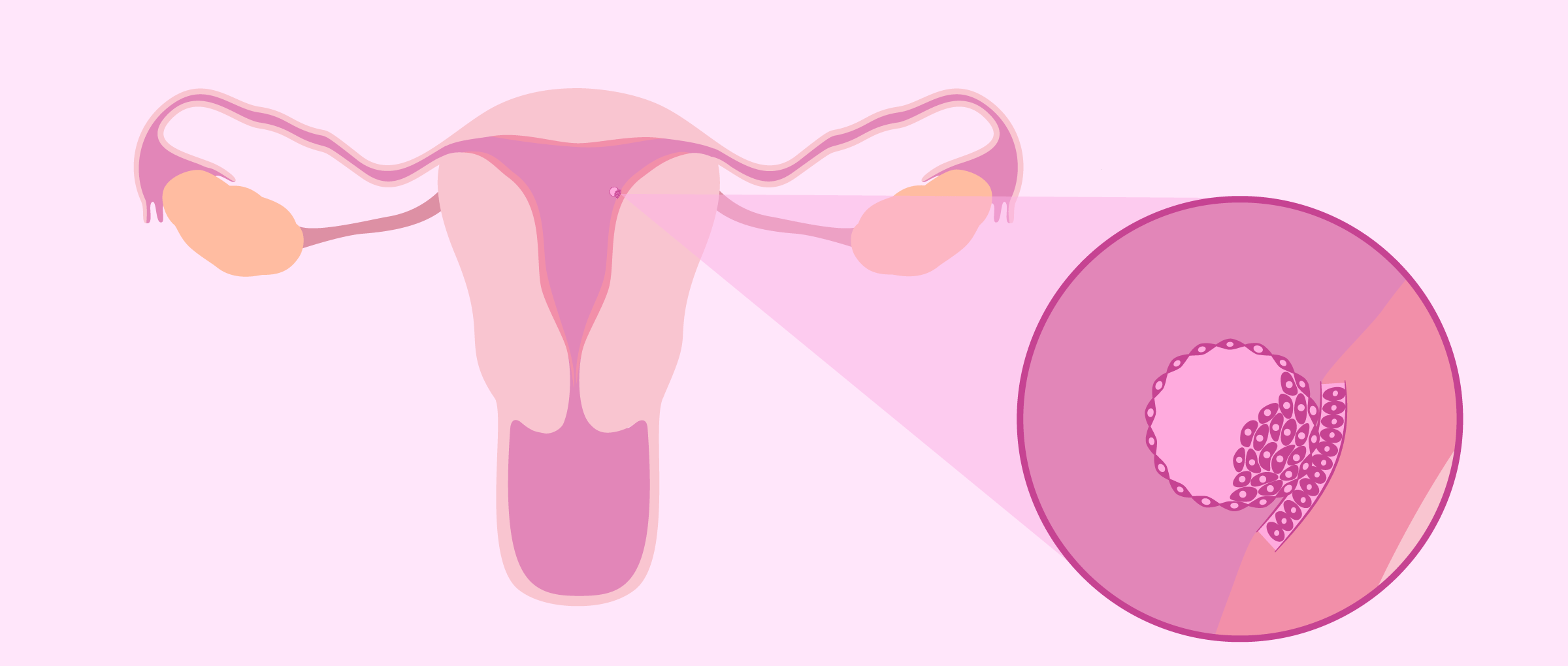 Nidação ou Implantação do Embrião na Decídua