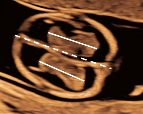 Acurácia da Proporção entre o Comprimento do Plexo Coróide e a Biometria do Polo Cefálico Fetal entre 11 e 13 Semanas para Diagnóstico de Espinha Bífida Aberta