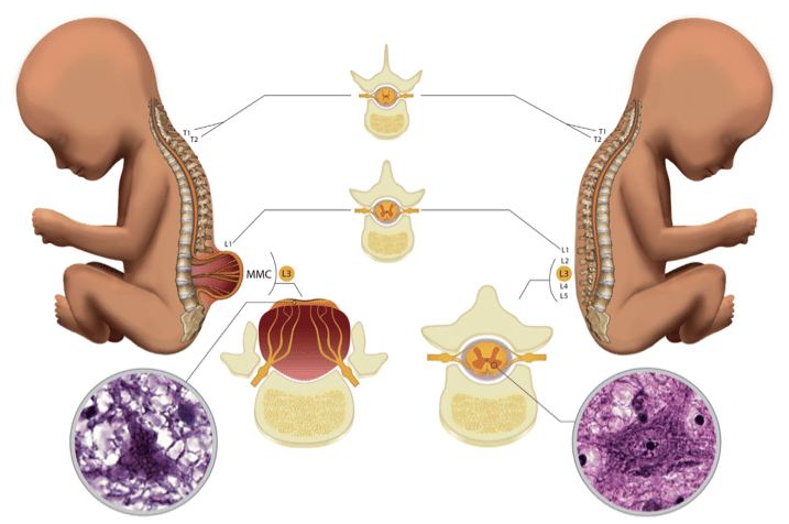 Perda Neuronal Mielomeningocele