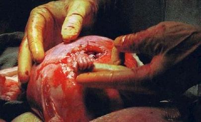 Cirurgia Fetal - Samuel Armas