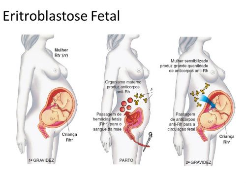 Eritroblastose Fetal - Isoimunização Rh - Doença Hemolítica Perinatal