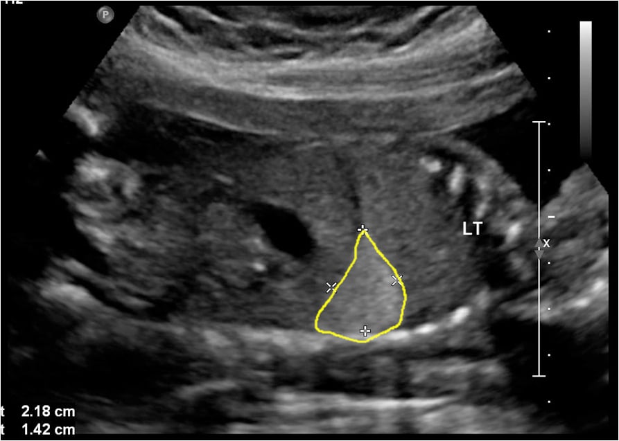 Ultrassom de sequestro pulmonar