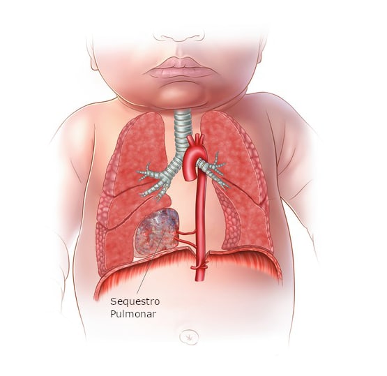 Sequestro Pulmonar