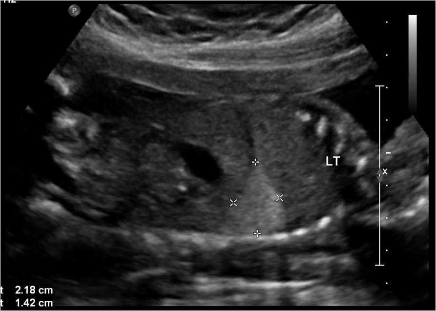 Ultrassom Sequestro Pulmonar