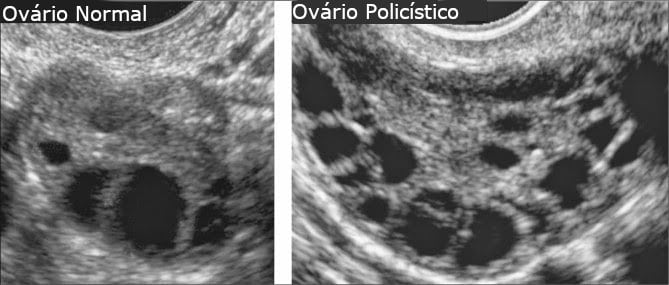 Ovário Policístico - Ultrassom