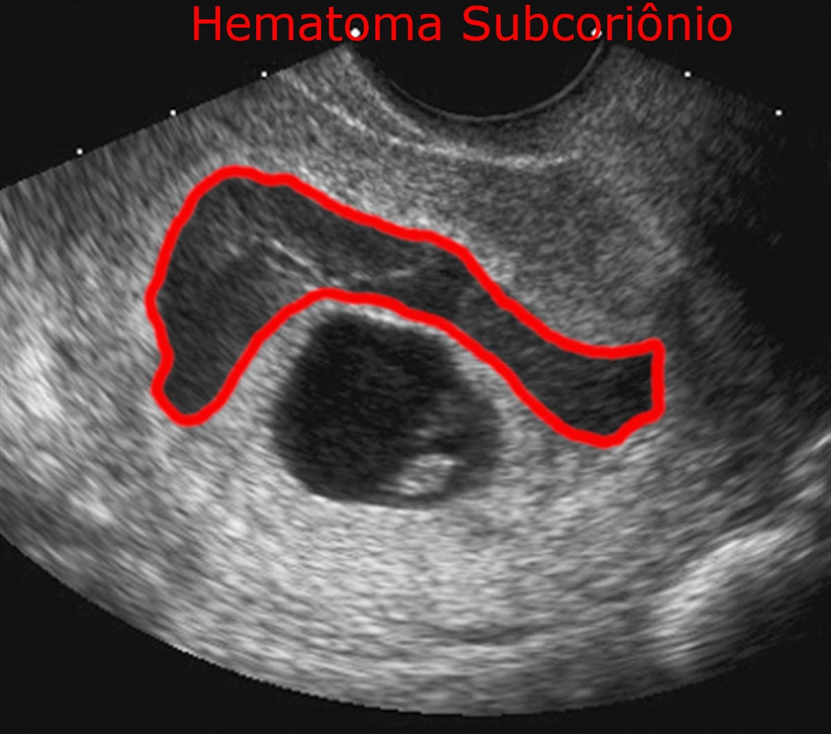 Ultrassom Hematoma Subcoriônico - Descolamento do Saco Gestacional