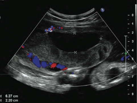 Ultrassom de Descolamento Prematuro de Placenta