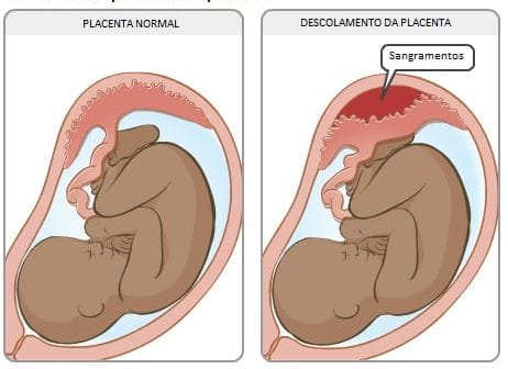 Descolamento Prematuro de Placenta