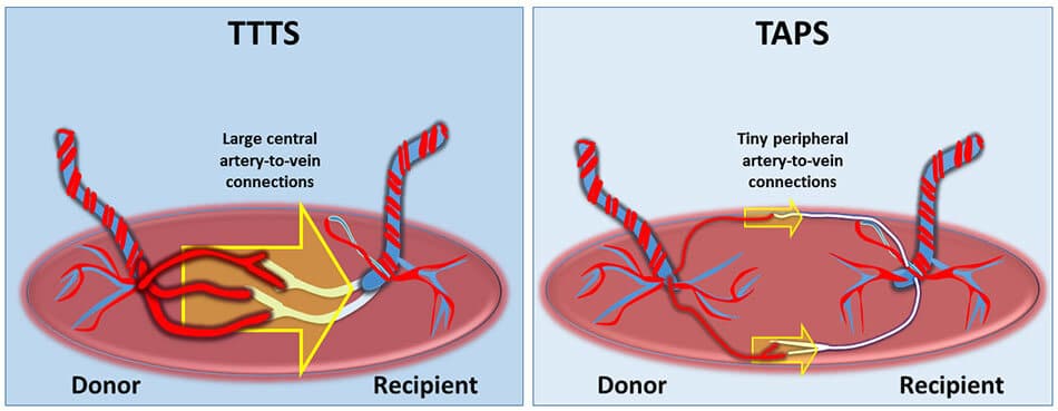 Ilustração Sequência de Anemia-Policitemia VERSUS Transfusão Feto-Fetal