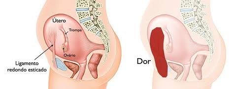 Dor do Ligamento Redondo