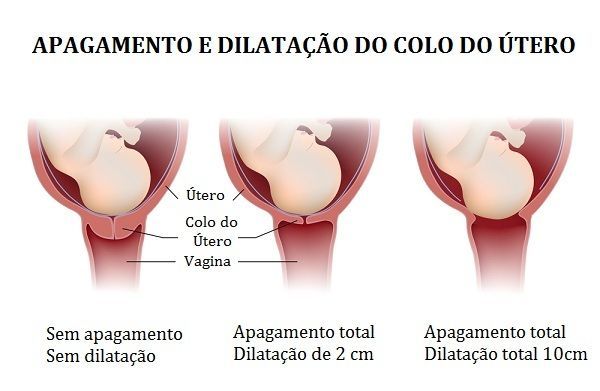 Apagamento e Dilatação do Colo Uterino