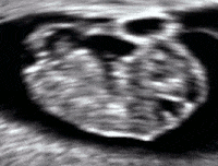 Bebê começa a mexer - ultrassom com 9 semanas