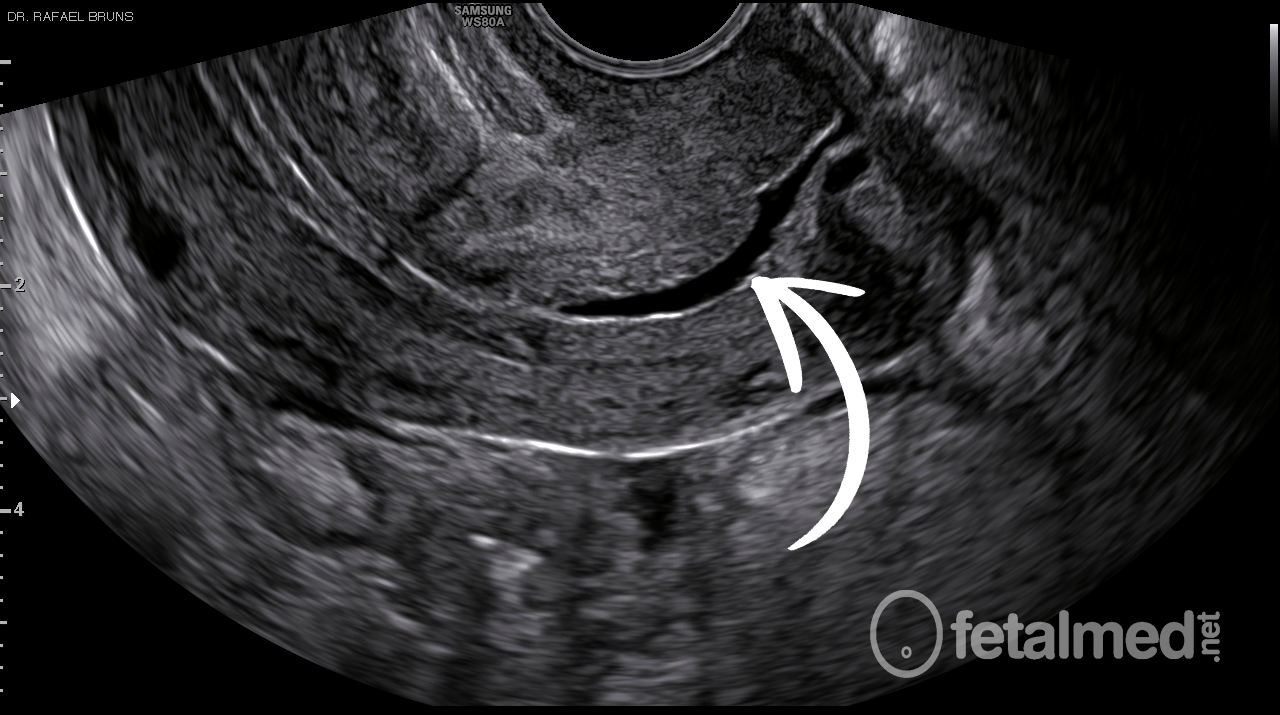 Muco Cervical