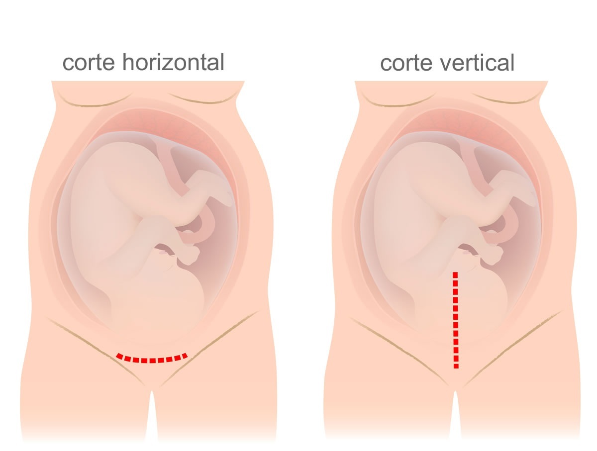 Diferentes cortes da cesárea