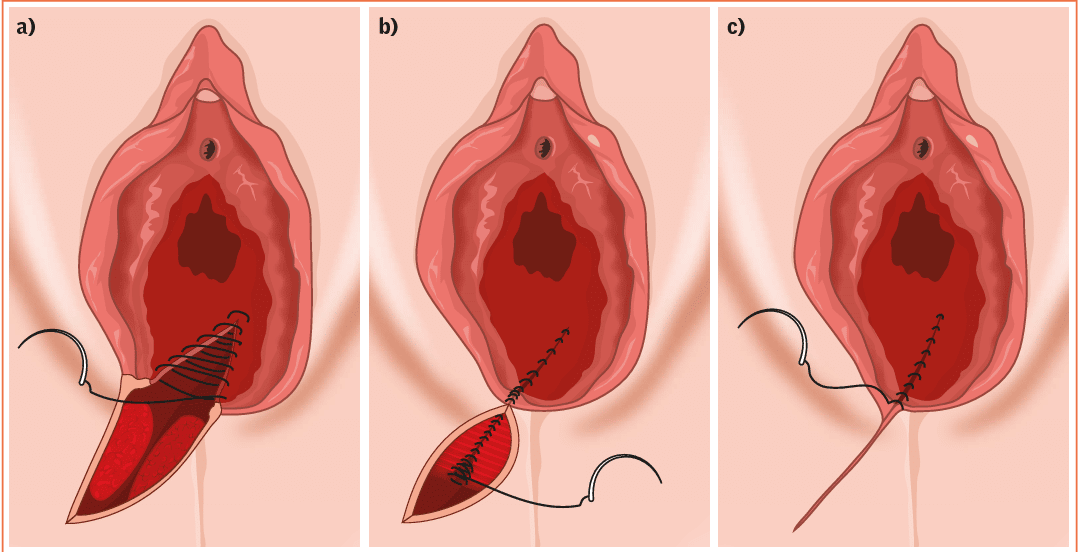 Sutura da Episiotomia
